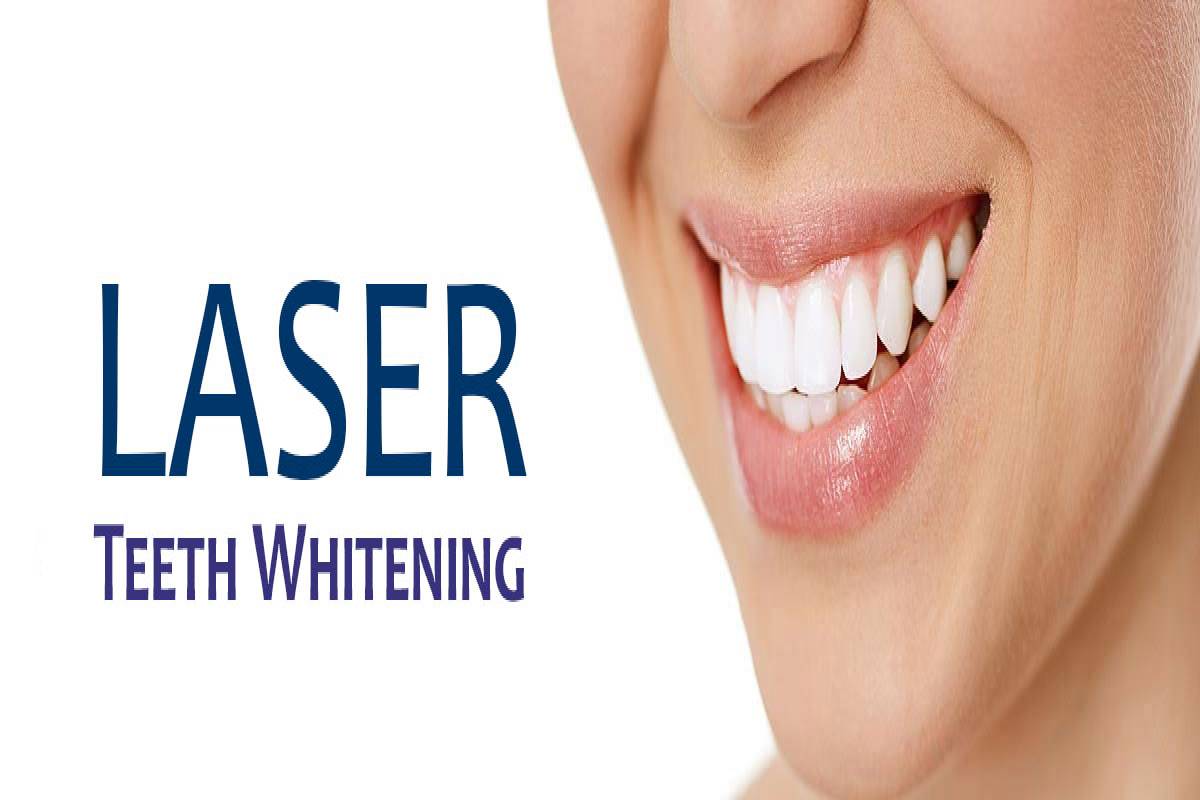  Laser Teeth Whitening – Advantages, Disadvantages, and More