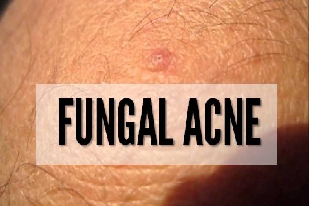 Fungal Acne – What Kills Fungal Acne, Routine to Avoid Fungal Acne, and More