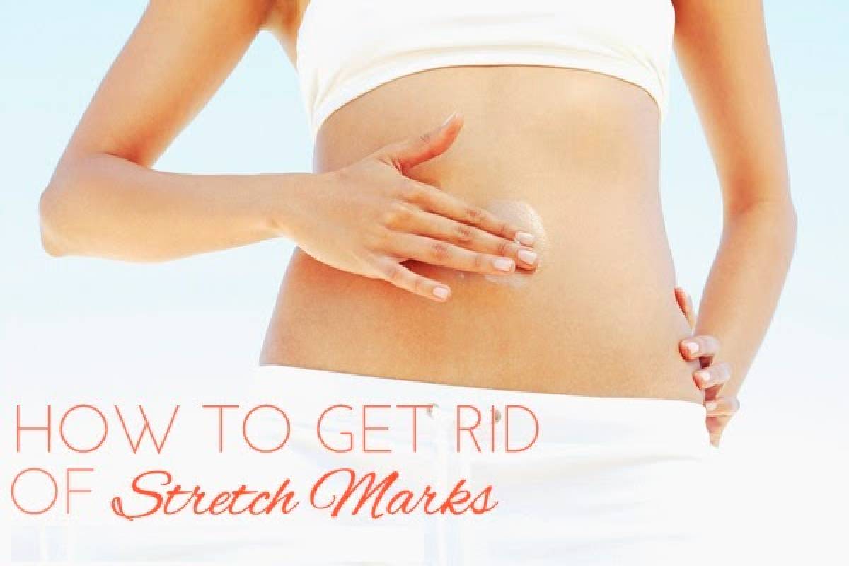  How to Get Rid of Stretch Marks? – Laser Treatment, Microneedles, and More