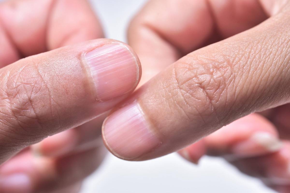 Ridges In Nails – Causes, Malabsorption, and More