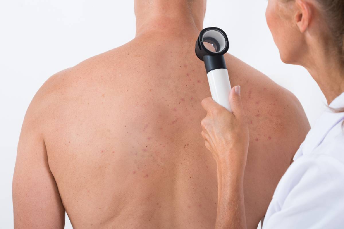 Back Acne – Basic Facts About Back Acne, and More