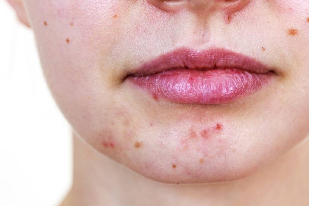 chin acne