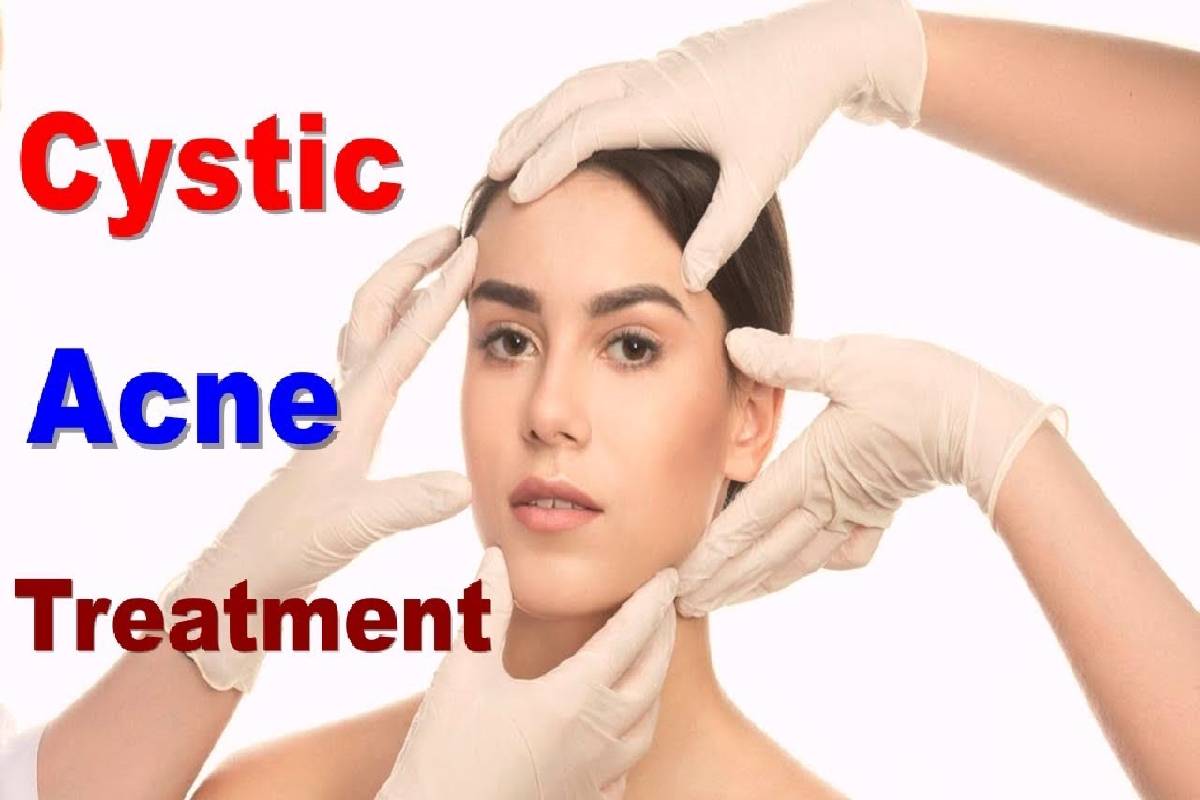  Cystic Acne Treatment – Treatments, Topical Retinoids, and More