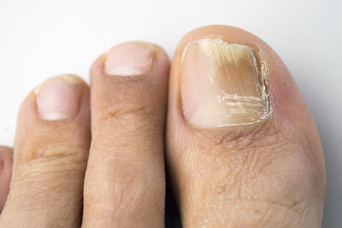  Nail Fungus – Treatments to Remove Nail Fungus