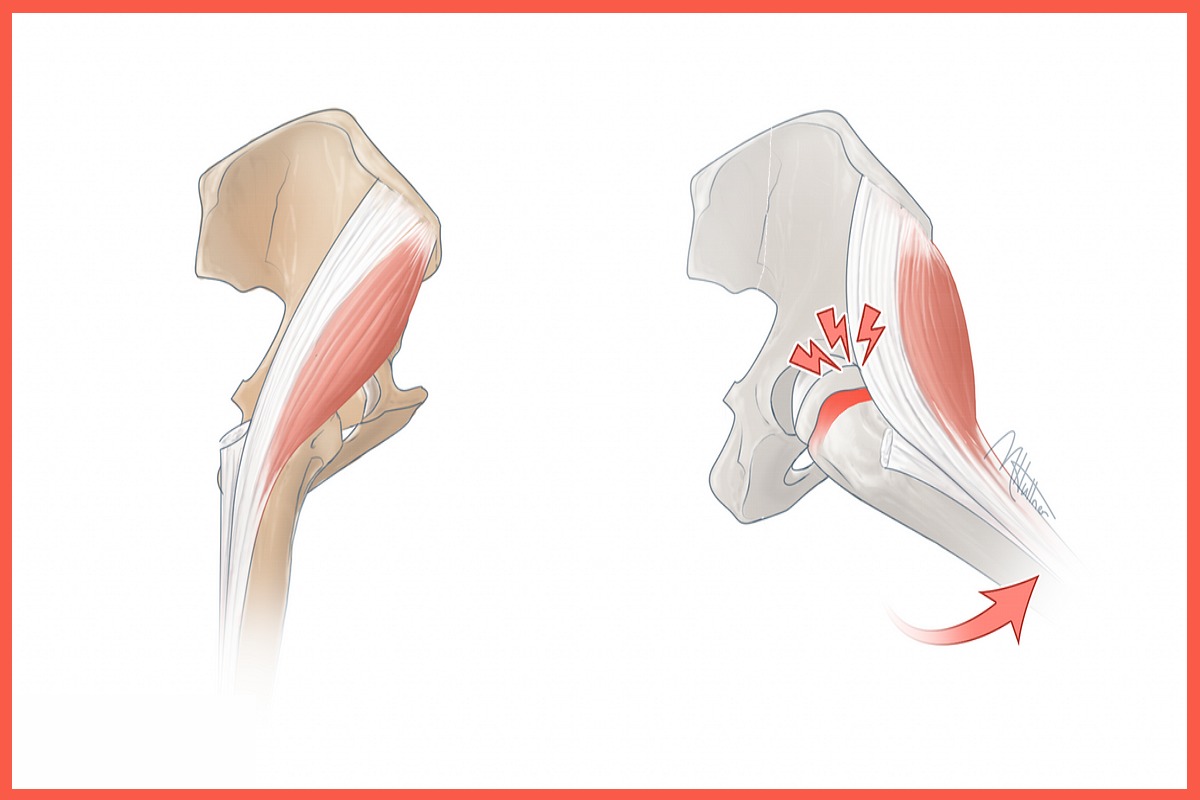  Snapping Hip Syndrome – What You Need To Know