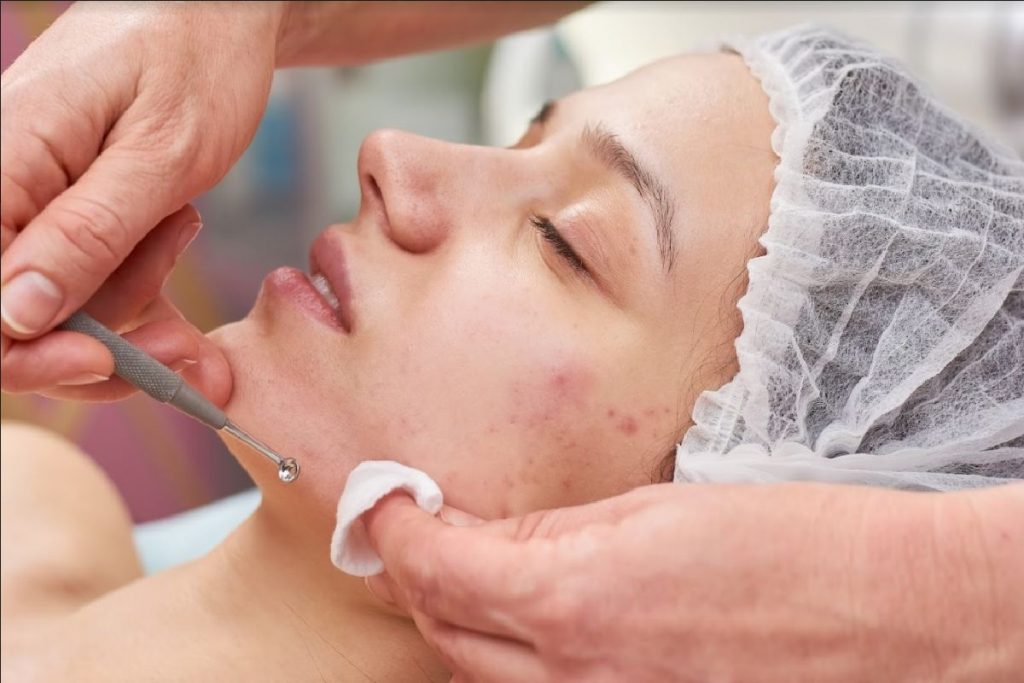 How To Choose The Right Acne Treatment For Your Skin