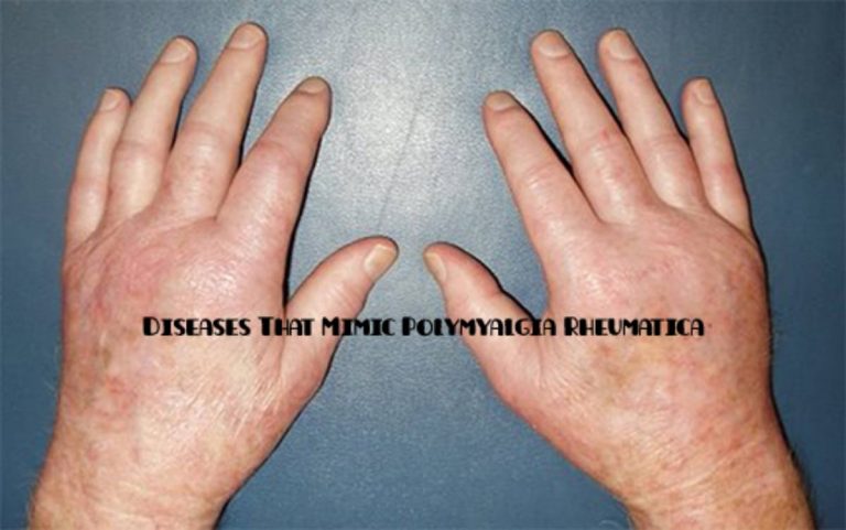 Diseases That Mimic Polymyalgia Rheumatica