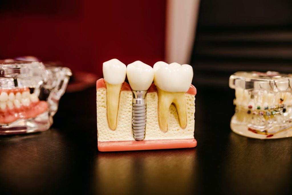 The Differences Between A Crown And An Implant
