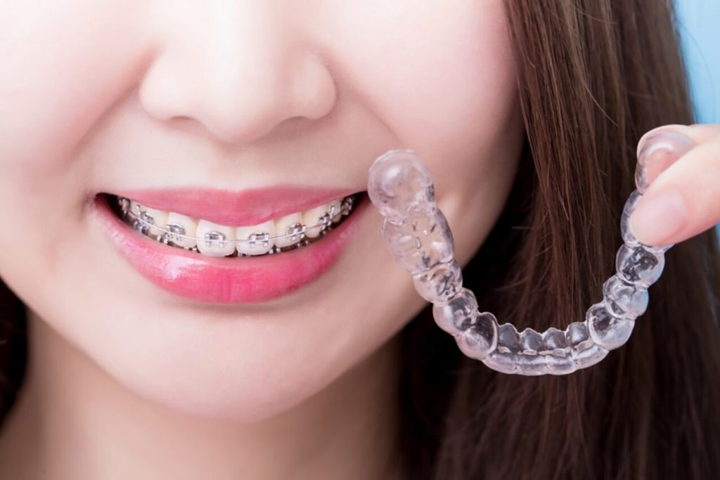 Health Benefits of Invisalign Braces