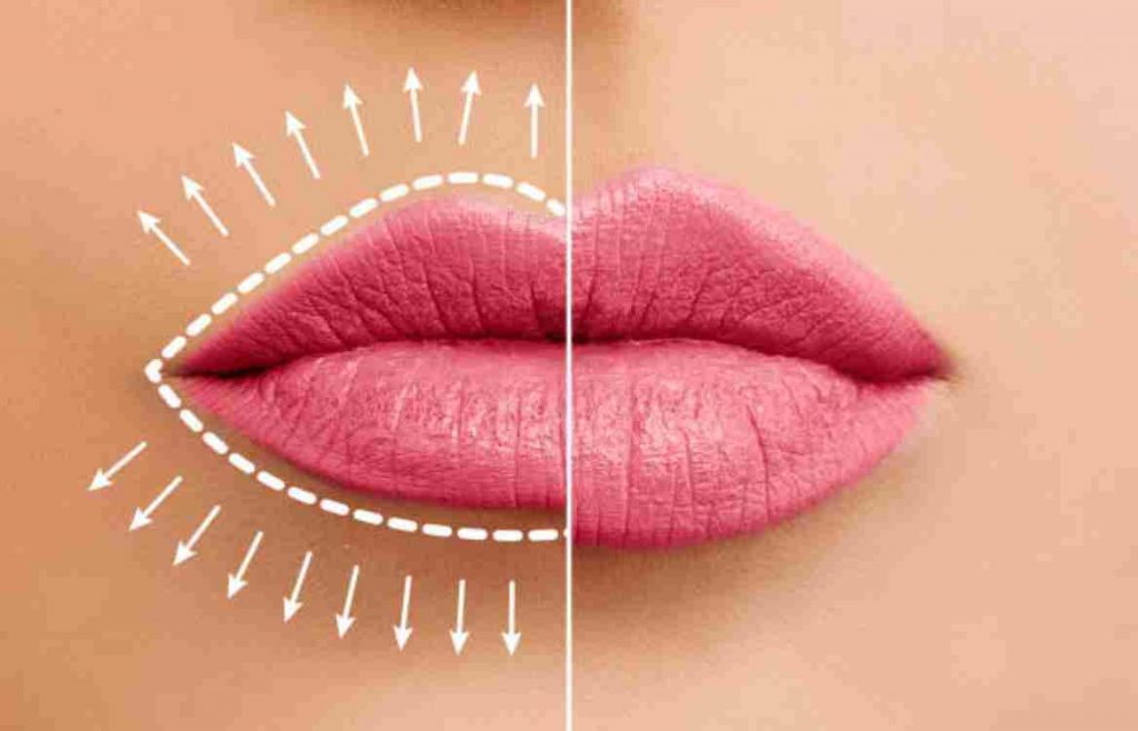 Lip Fillers