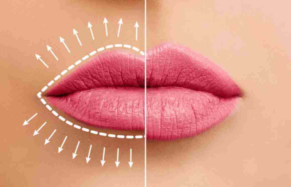  5 Reasons Why Lip Fillers Have Become So Popular