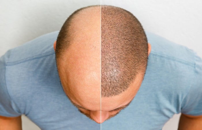 Hair Transplant Write for Us - Accept Guest Posts, Submit and Contribute Posts.