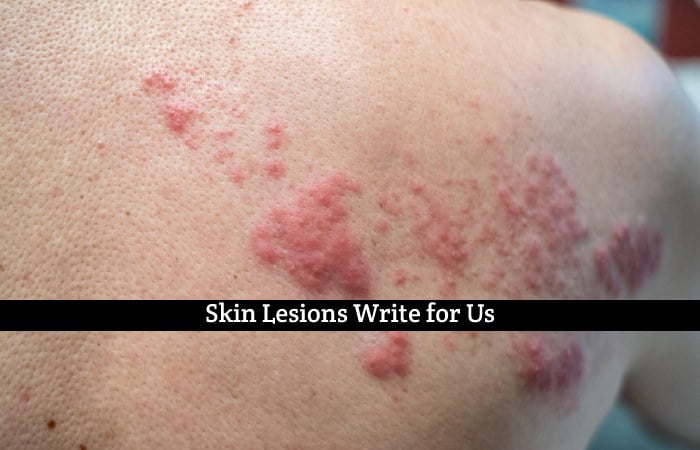 Skin Lesions Write for Us - Accept Guest Posts, Submit and Contribute Posts.