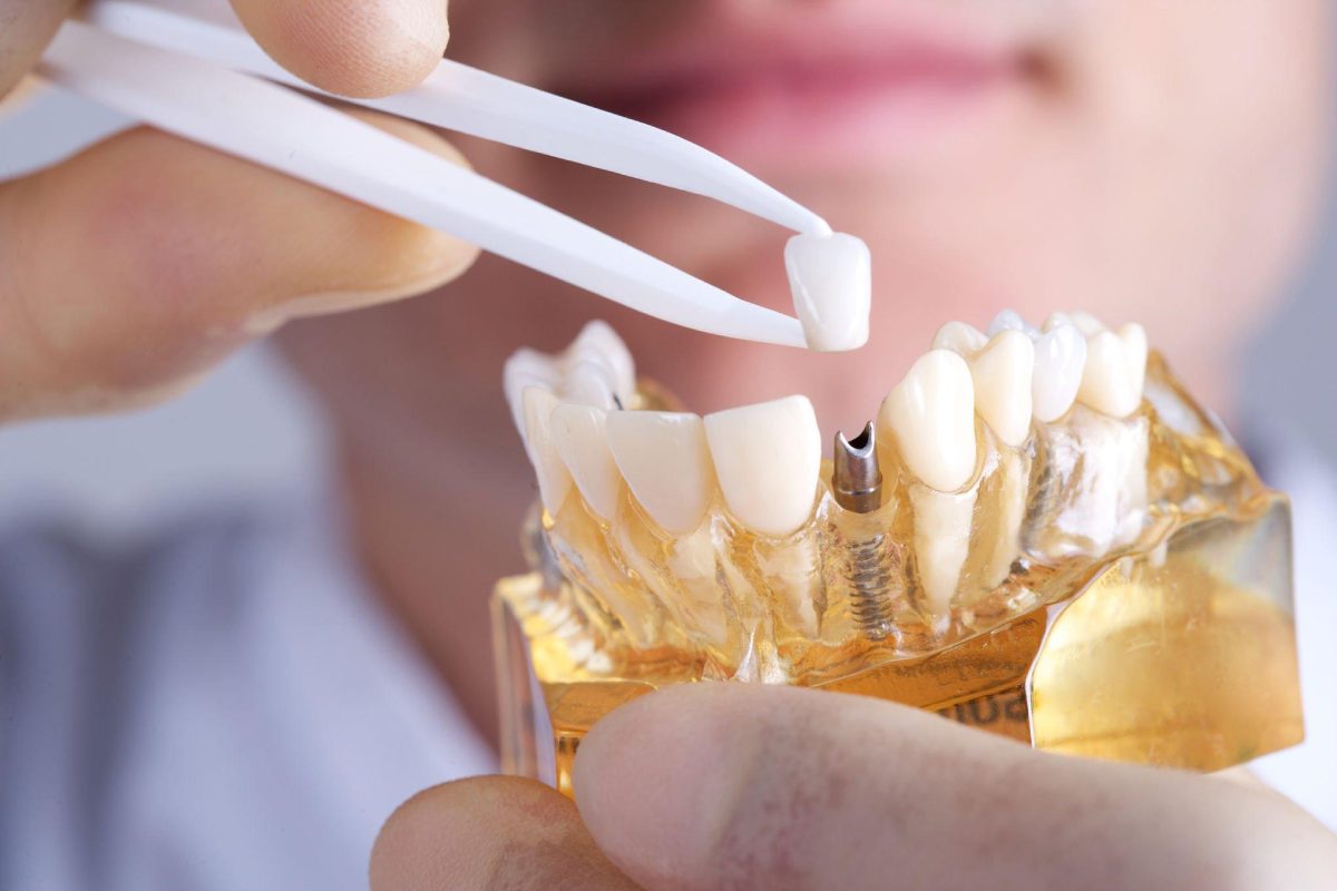 Dental Implant-