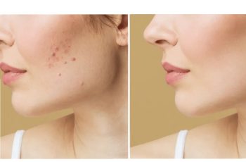 4 Skin Care For Acne Scars For Dark Spot