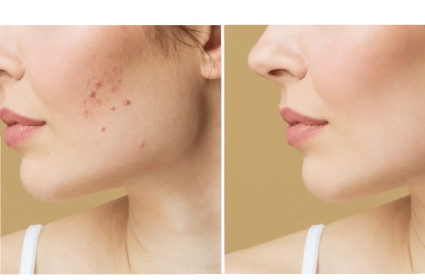  4 Skin Care For Acne Scars For Dark Spot
