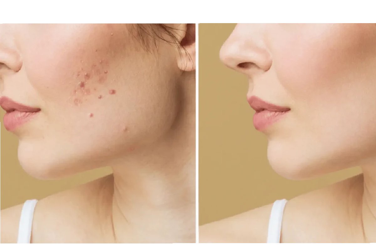 4 Skin Care For Acne Scars For Dark Spot