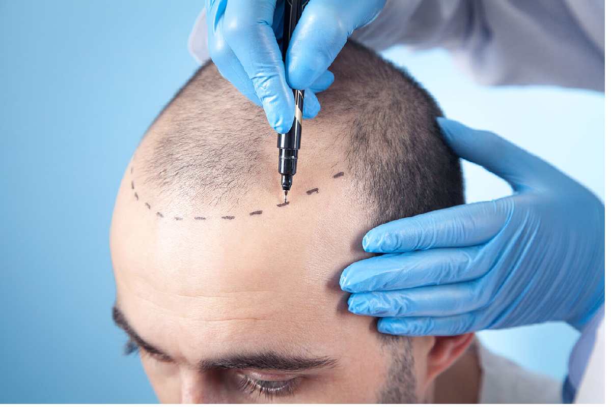 Hair Transplant